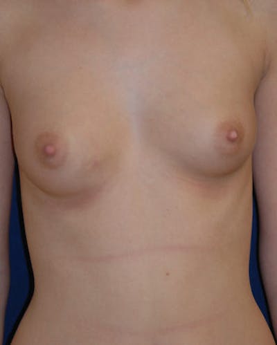 Breast Augmentation Before & After Gallery - Patient 106356 - Image 1