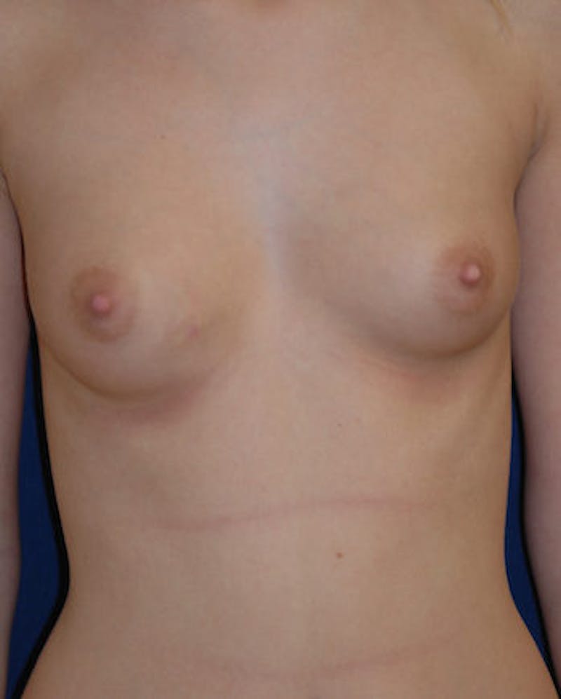 Breast Augmentation Before & After Gallery - Patient 106356 - Image 1