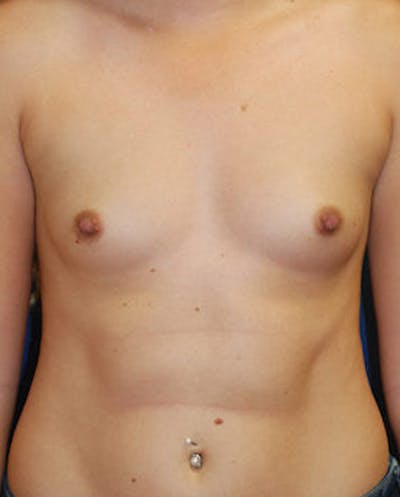 Breast Augmentation Before & After Gallery - Patient 127289 - Image 1
