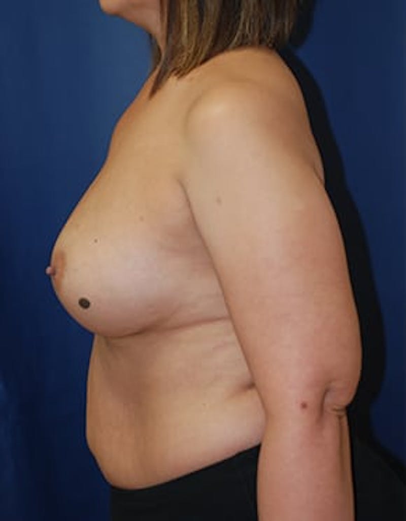 Breast Augmentation Before & After Gallery - Patient 393795 - Image 6