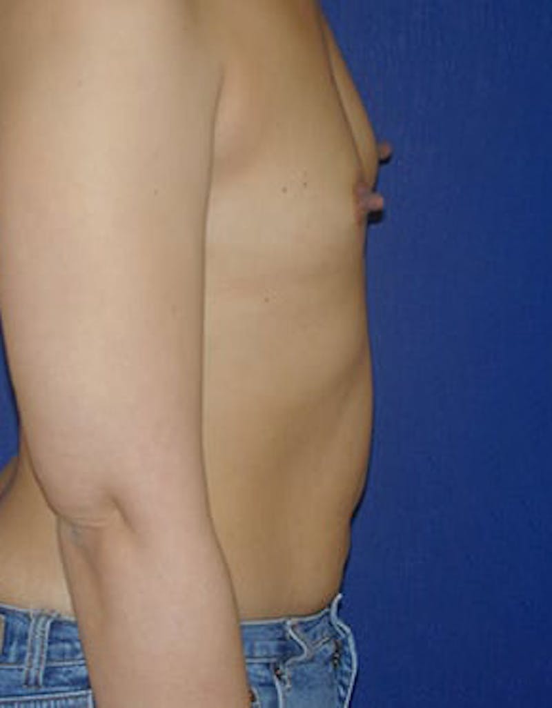 Breast Augmentation Before & After Gallery - Patient 393795 - Image 4