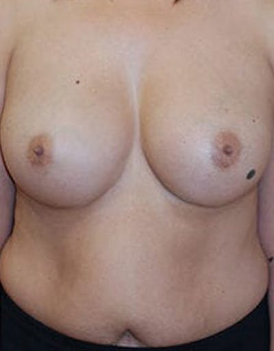 Breast Augmentation Before & After Gallery - Patient 393795 - Image 2