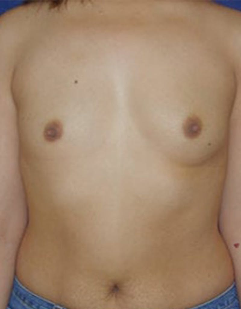 Breast Augmentation Before & After Gallery - Patient 393795 - Image 1