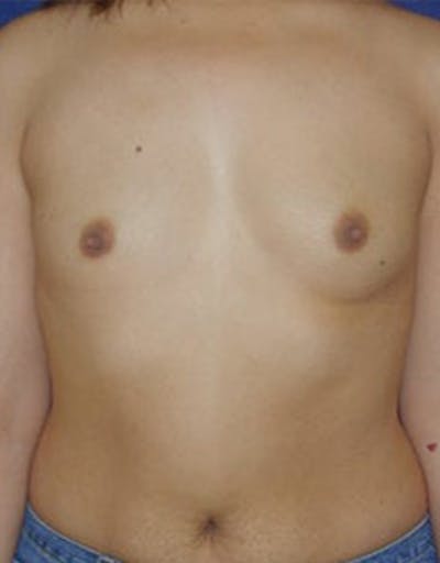 Breast Augmentation Before & After Gallery - Patient 393795 - Image 1