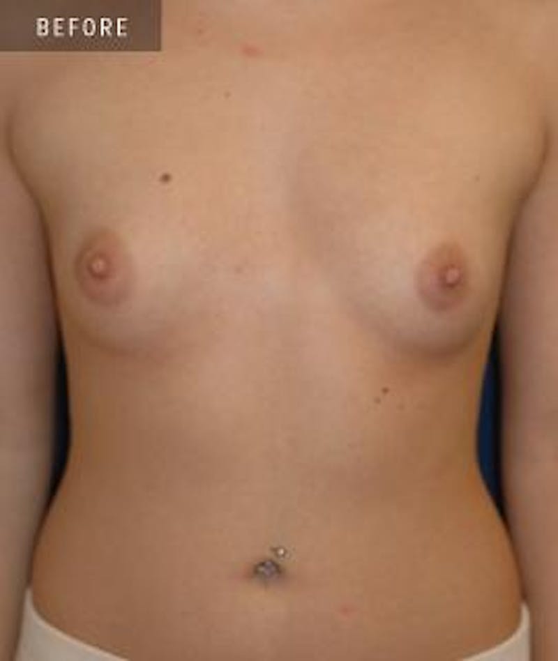 Breast Augmentation Before & After Gallery - Patient 233665 - Image 1