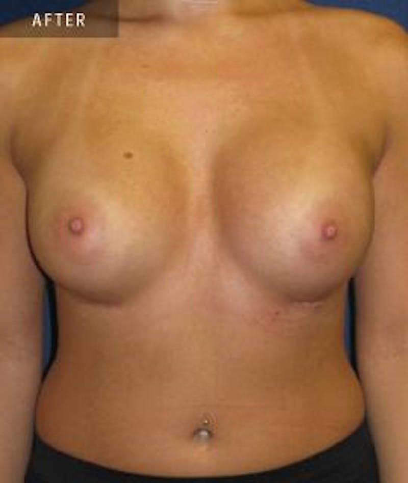 Breast Augmentation Before & After Gallery - Patient 233665 - Image 2