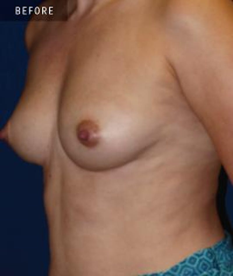 Breast Augmentation Before & After Gallery - Patient 177696 - Image 1