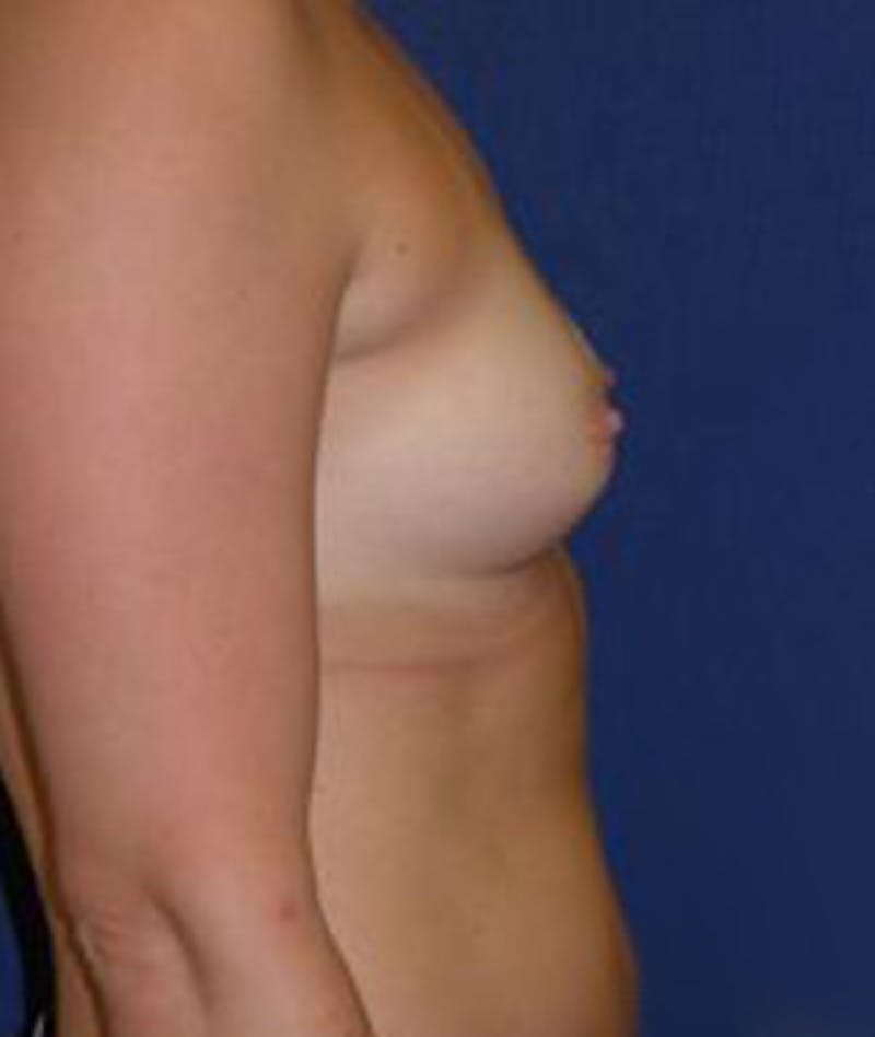 Breast Augmentation Before & After Gallery - Patient 259048 - Image 3