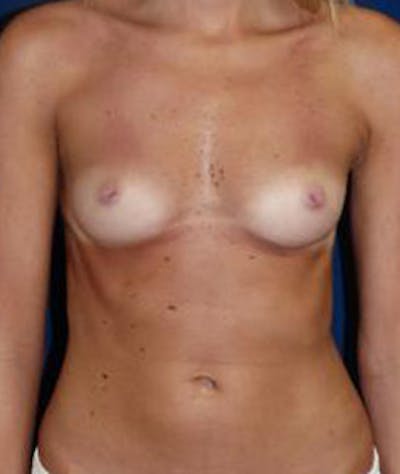 Breast Augmentation Before & After Gallery - Patient 378092 - Image 1