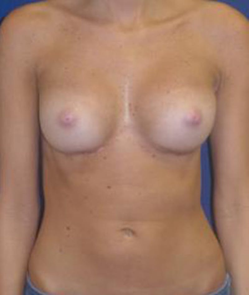 Breast Augmentation Before & After Gallery - Patient 378092 - Image 2