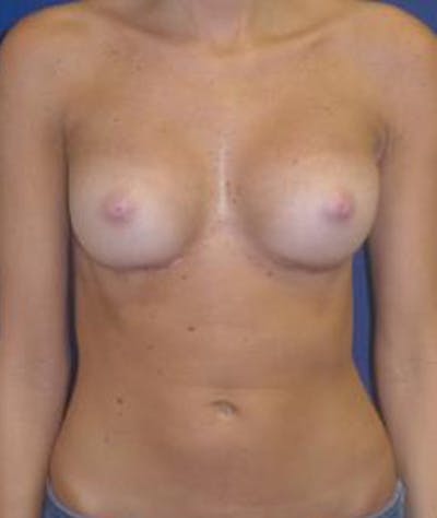 Breast Augmentation Before & After Gallery - Patient 378092 - Image 2