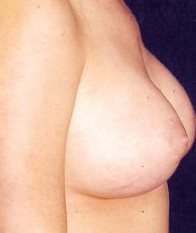 Breast Augmentation Before & After Gallery - Patient 374977 - Image 4