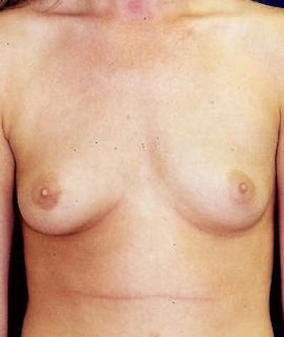 Breast Augmentation Before & After Gallery - Patient 374977 - Image 1