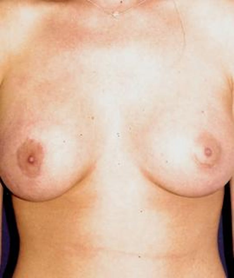 Breast Augmentation Before & After Gallery - Patient 374977 - Image 2