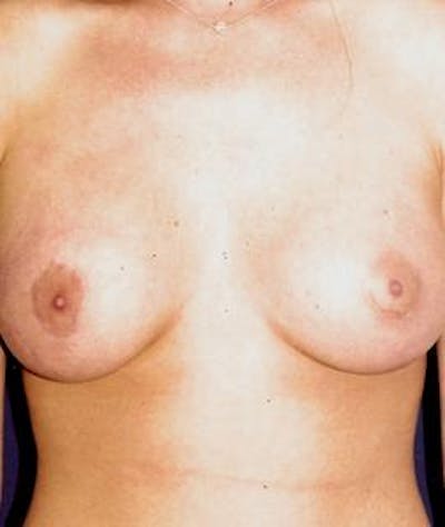 Breast Augmentation Before & After Gallery - Patient 374977 - Image 2