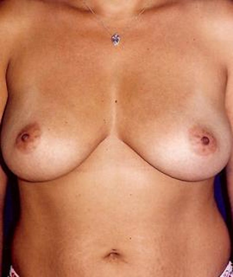 Breast Augmentation Before & After Gallery - Patient 169303 - Image 1