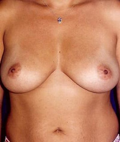 Breast Augmentation Before & After Gallery - Patient 169303 - Image 1