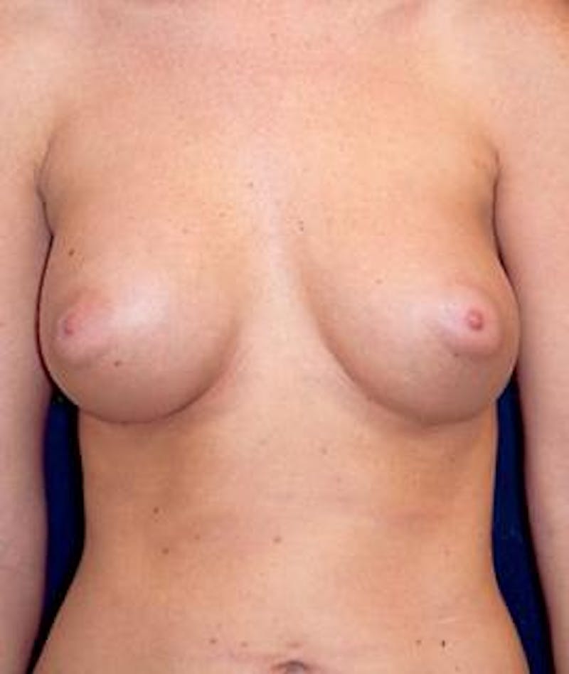 Breast Augmentation Before & After Gallery - Patient 287851 - Image 2