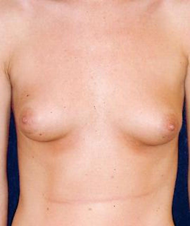 Breast Augmentation Before & After Gallery - Patient 287851 - Image 1