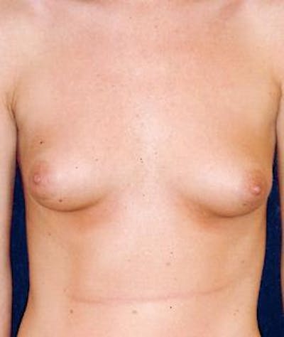 Breast Augmentation Before & After Gallery - Patient 287851 - Image 1