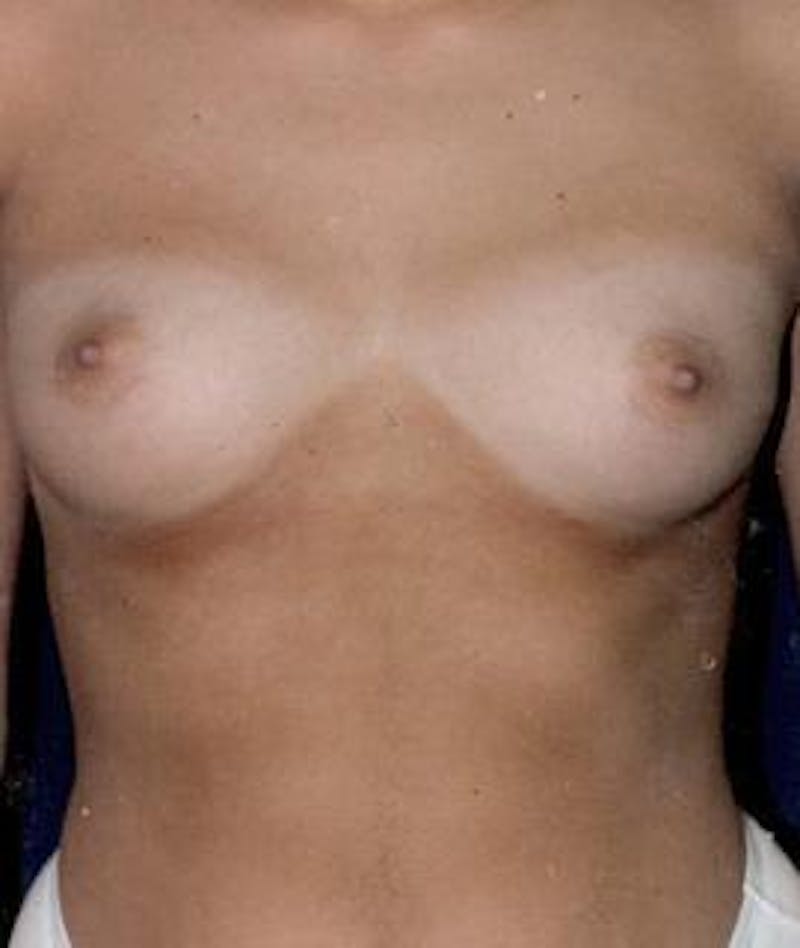 Breast Augmentation Before & After Gallery - Patient 226029 - Image 1