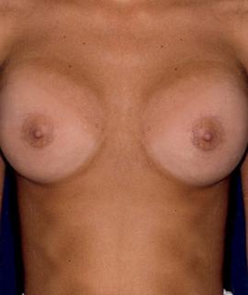 Breast Augmentation Before & After Gallery - Patient 226029 - Image 2