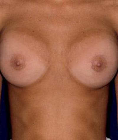 Breast Augmentation Before & After Gallery - Patient 226029 - Image 2