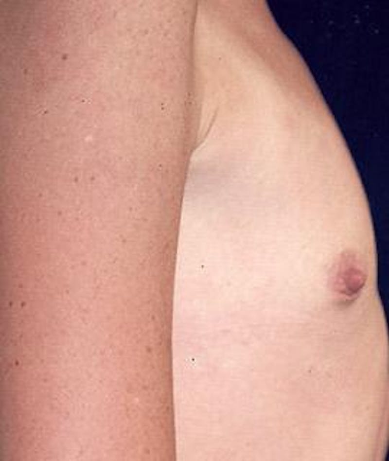 Breast Augmentation Before & After Gallery - Patient 423373 - Image 3