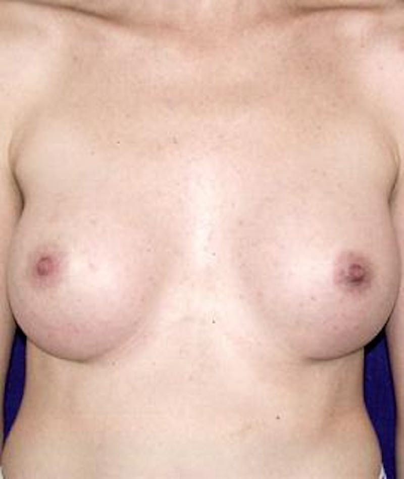 Breast Augmentation Before & After Gallery - Patient 423373 - Image 2