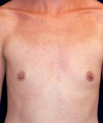 Breast Augmentation Before & After Gallery - Patient 423373 - Image 1