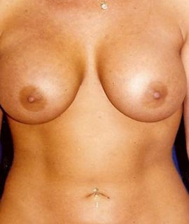 Breast Augmentation Before & After Gallery - Patient 316480 - Image 2