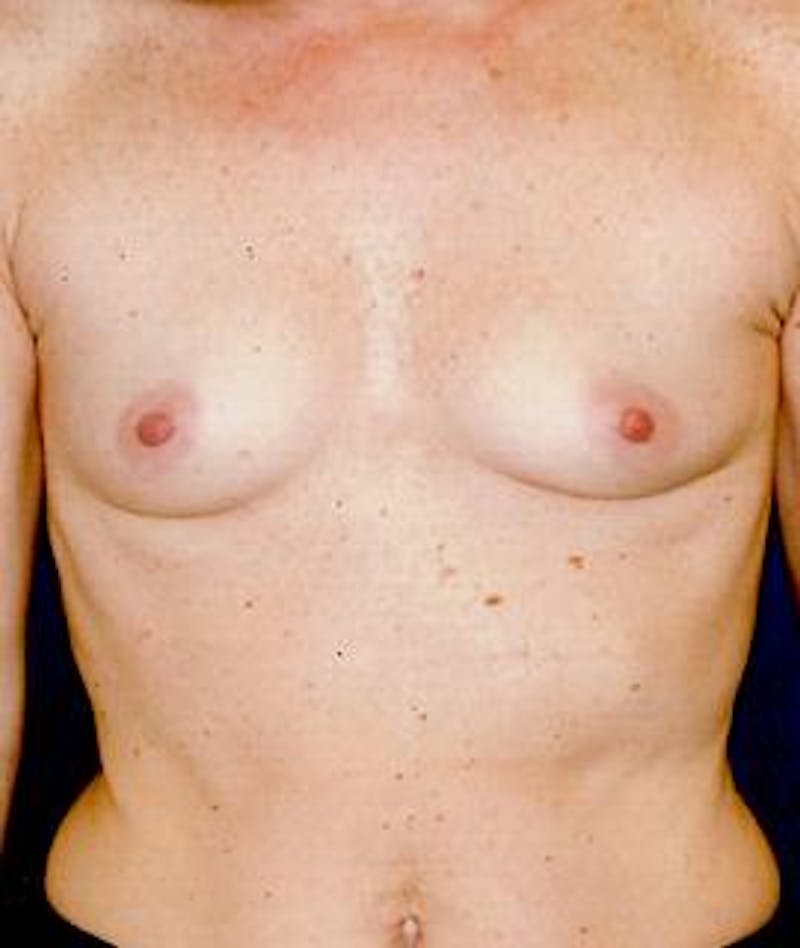 Breast Augmentation Before & After Gallery - Patient 292971 - Image 1