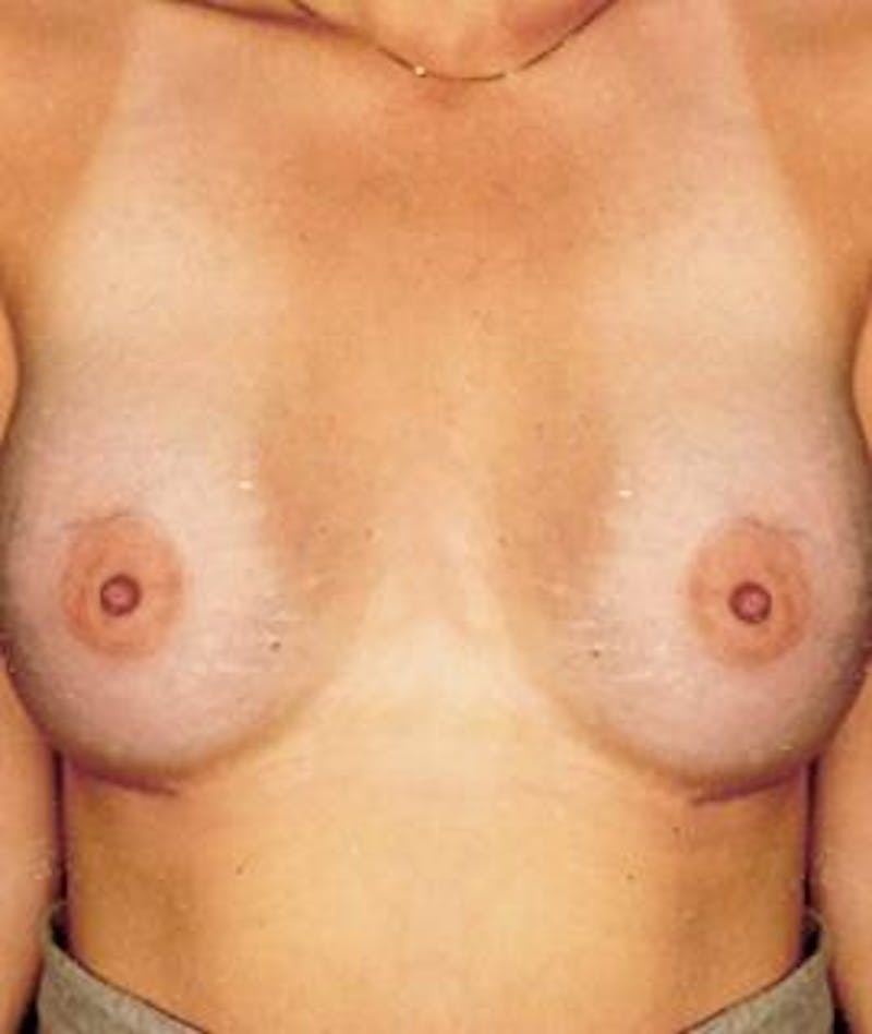 Breast Augmentation Before & After Gallery - Patient 350739 - Image 2