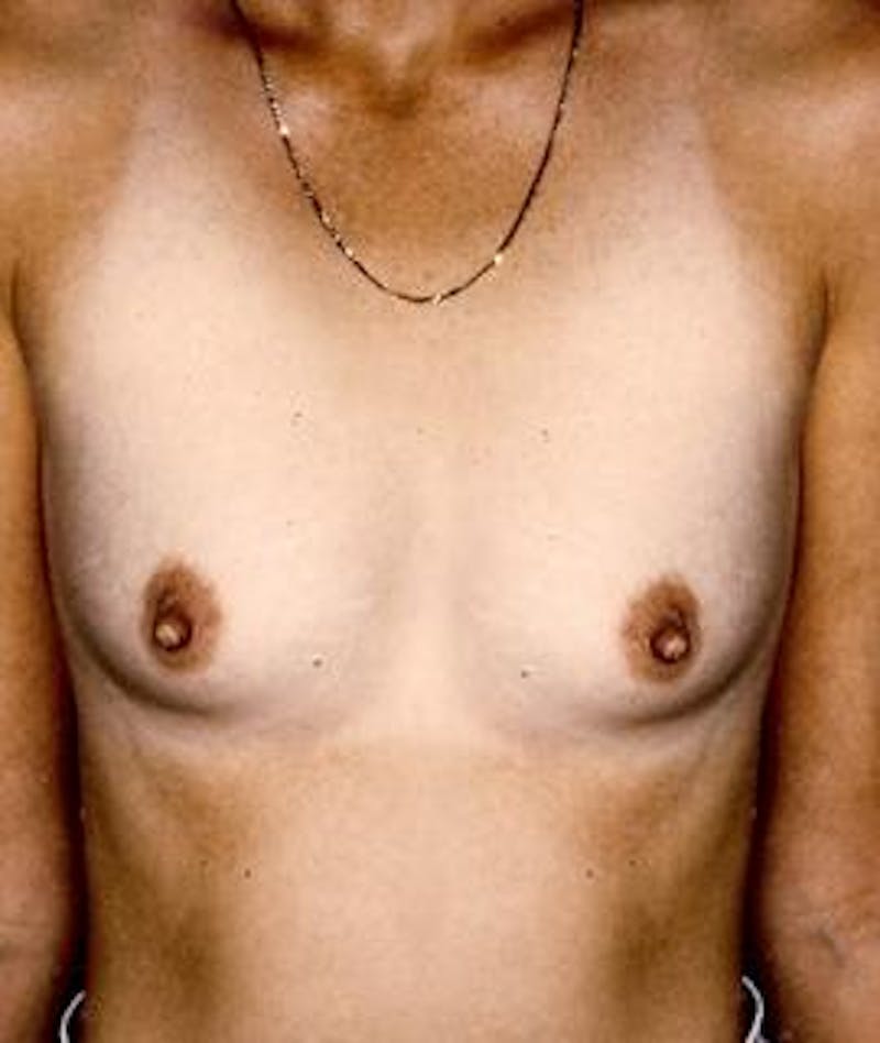 Breast Augmentation Before & After Gallery - Patient 350739 - Image 1