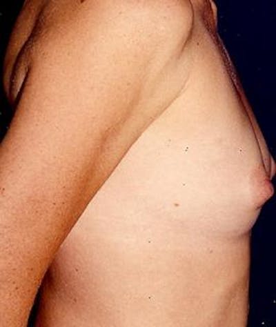 Breast Augmentation Before & After Gallery - Patient 193893 - Image 1