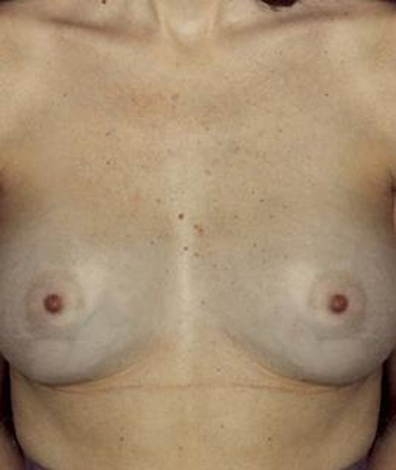 Breast Augmentation Before & After Gallery - Patient 370474 - Image 2
