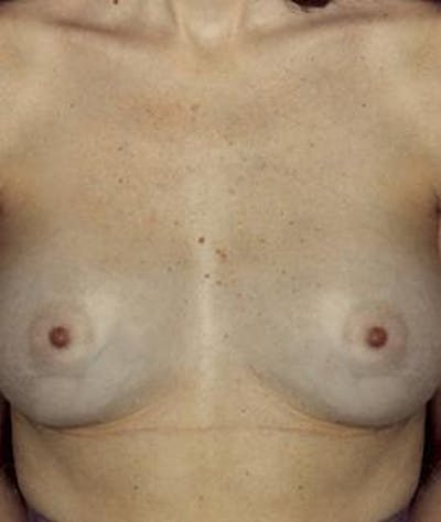 Breast Augmentation Before & After Gallery - Patient 370474 - Image 2