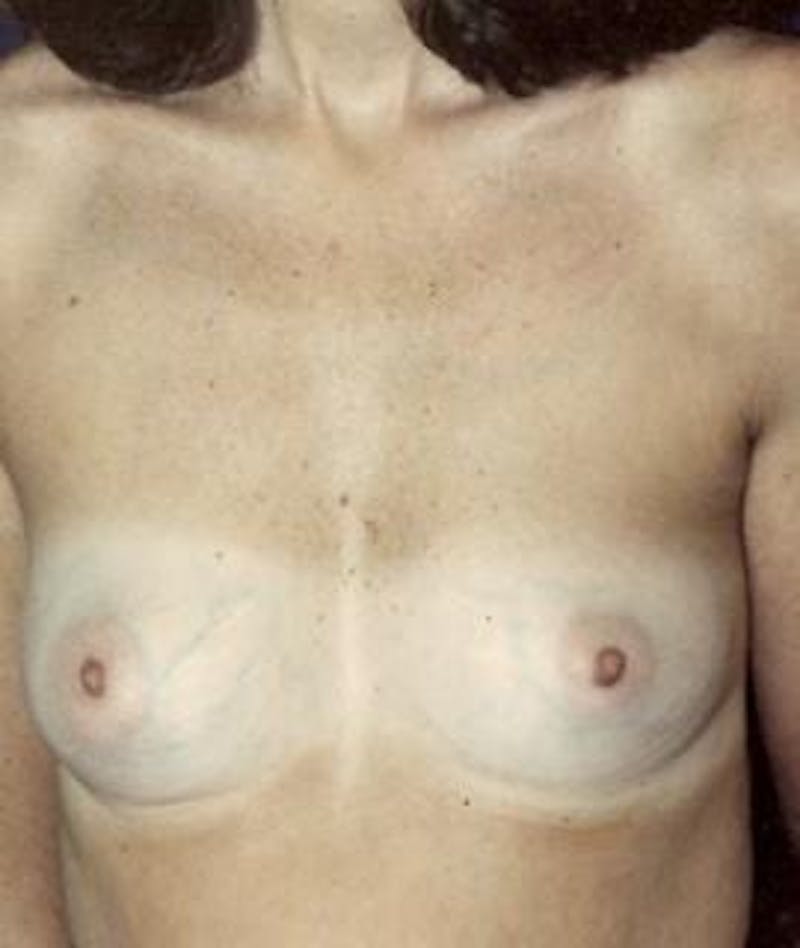 Breast Augmentation Before & After Gallery - Patient 370474 - Image 1