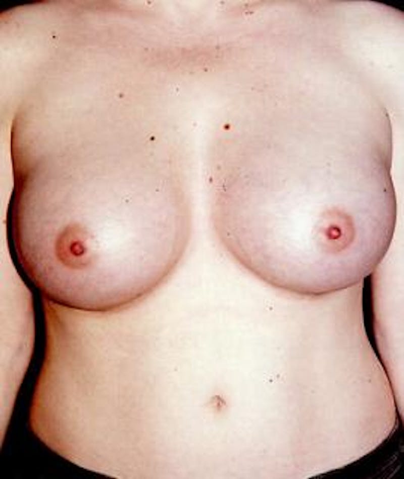 Breast Augmentation Before & After Gallery - Patient 298564 - Image 2