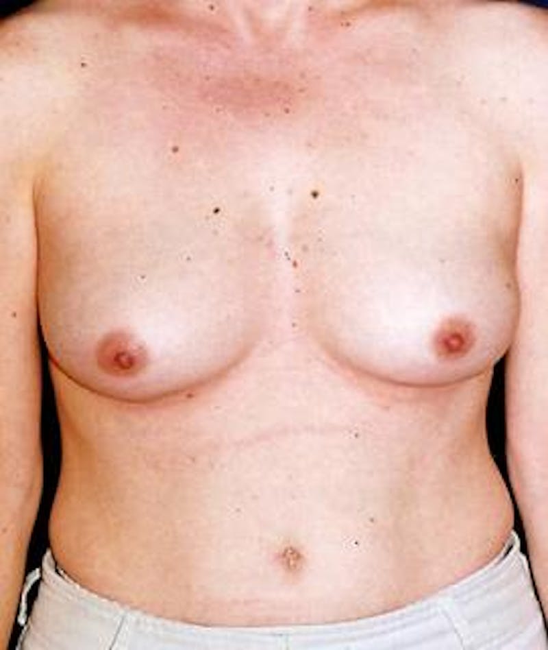 Breast Augmentation Before & After Gallery - Patient 298564 - Image 1