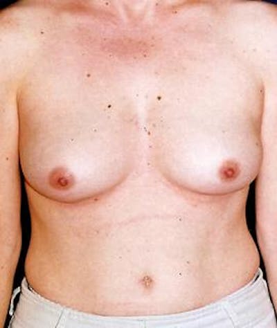 Breast Augmentation Before & After Gallery - Patient 298564 - Image 1