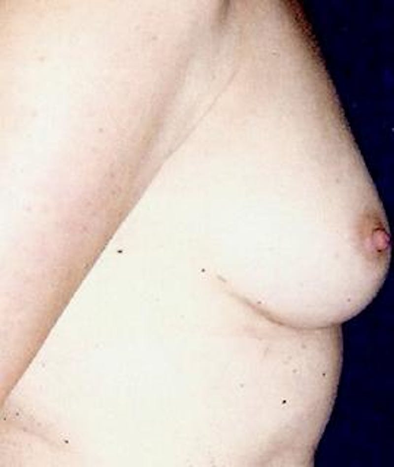 Breast Augmentation Before & After Gallery - Patient 300742 - Image 3