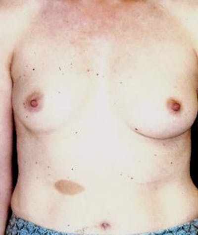 Breast Augmentation Before & After Gallery - Patient 300742 - Image 1