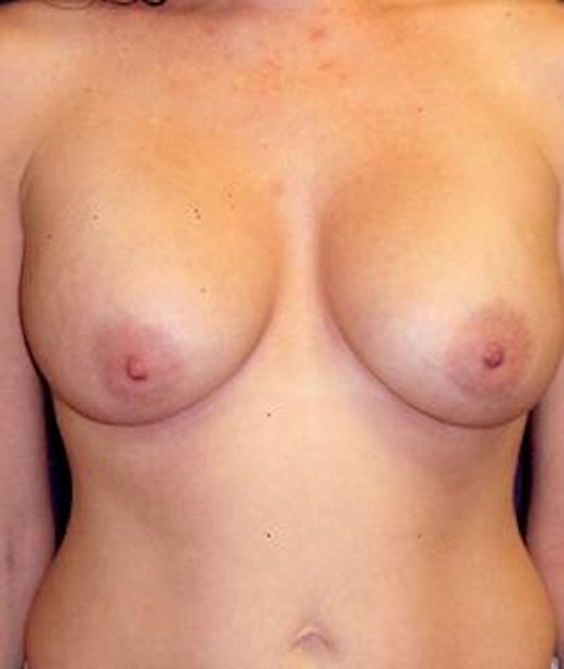 Breast Augmentation Before & After Gallery - Patient 327392 - Image 2