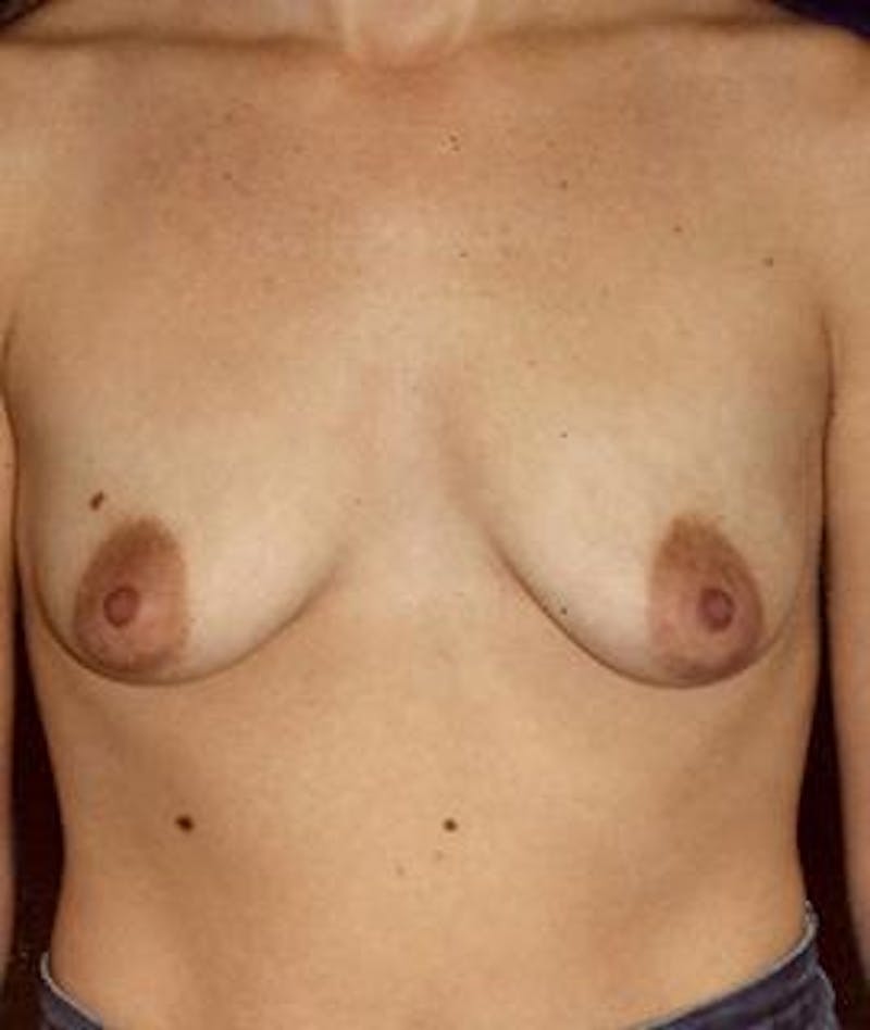 Breast Augmentation Before & After Gallery - Patient 404647 - Image 1