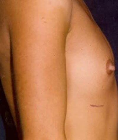 Breast Augmentation Before & After Gallery - Patient 553992 - Image 1