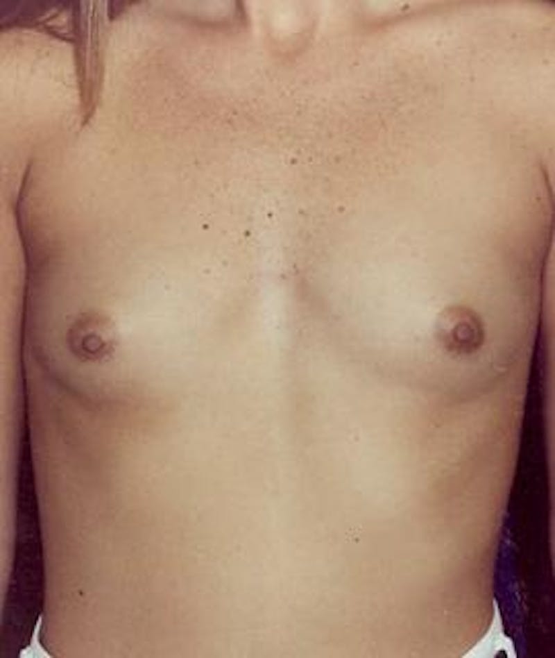 Breast Augmentation Before & After Gallery - Patient 801589 - Image 1