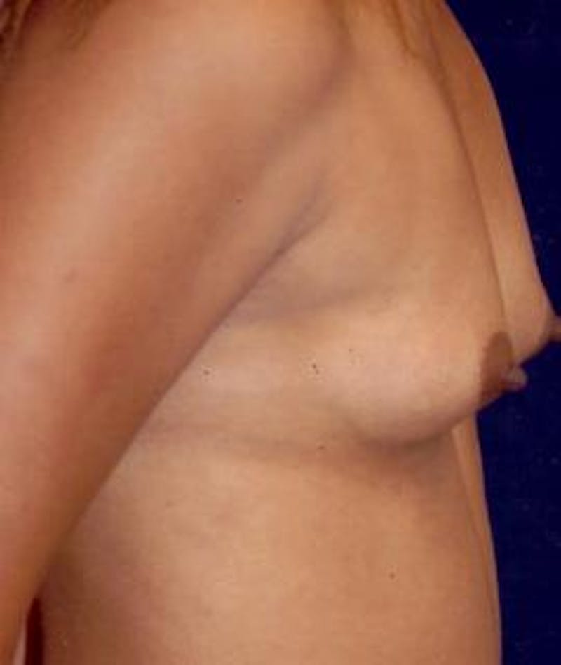 Breast Augmentation Before & After Gallery - Patient 391790 - Image 3