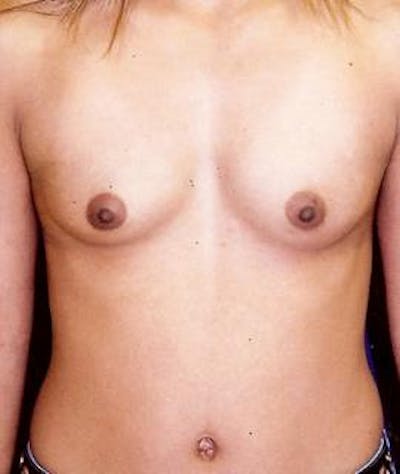 Breast Augmentation Before & After Gallery - Patient 391790 - Image 1