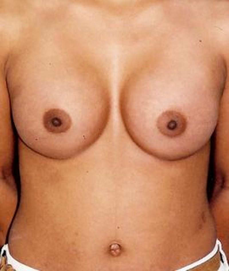 Breast Augmentation Before & After Gallery - Patient 391790 - Image 2